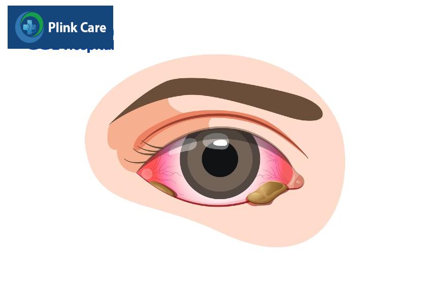 ghèn nhiều có thể là dấu hiệu nhiễm trùng