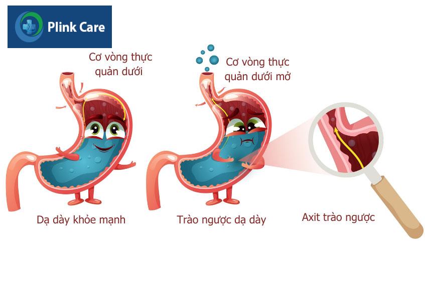 Hình ảnh dạ dày khỏe mạnh và dạ dày bị trào ngược
