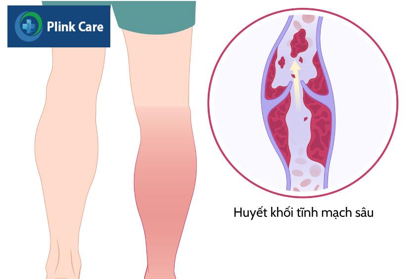 Hình ảnh minh họa tình trạng thuyên tắc huyết khối tĩnh mạch sâu