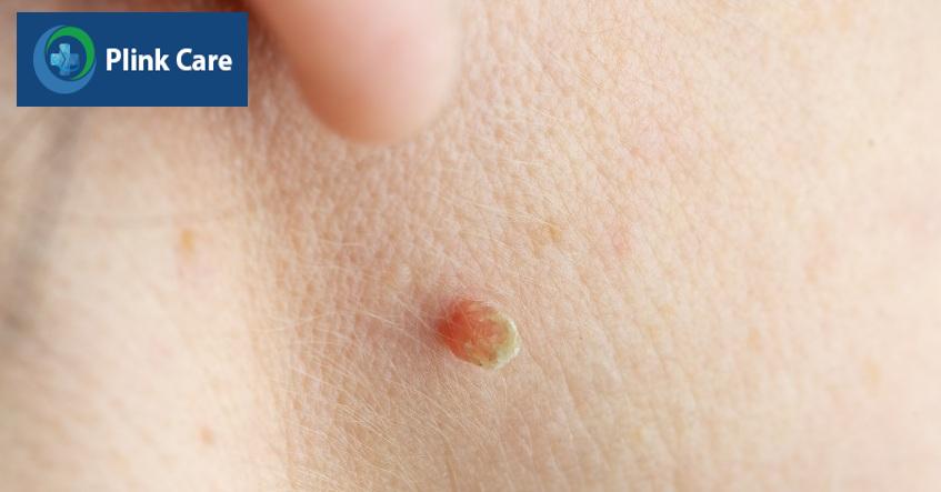 hình ảnh mụn thịt phát triển trên cổ