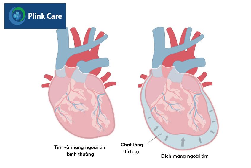Hình ảnh trái tim bình thường và trái tim có dịch màng ngoài tim