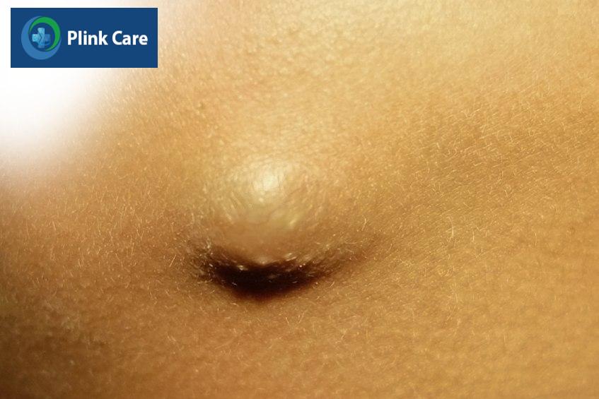 hình ảnh u bã đậu ở mông của người bệnh