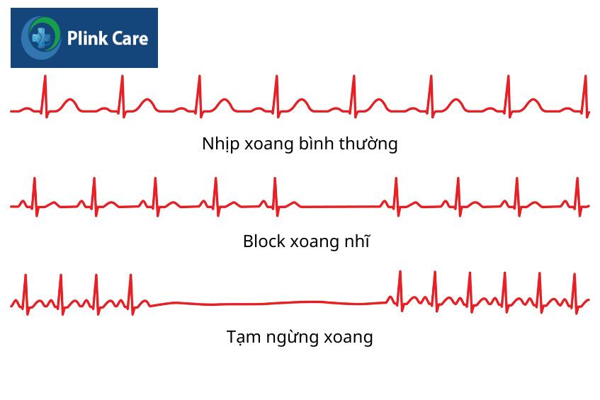 Hình ảnh minh họa ECG thể hiện các tình trạng của nút xoang nhĩ