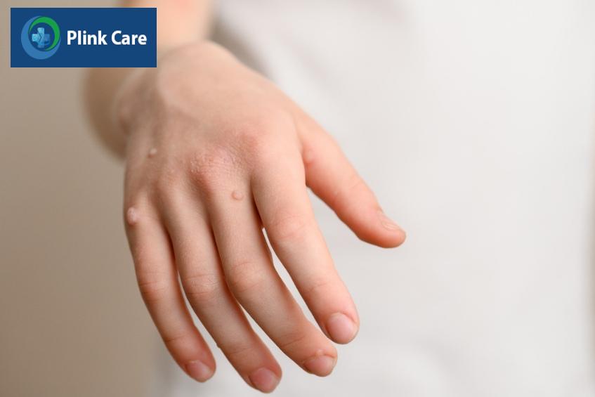 hpv có thể gây nhiều bệnh ở nam giới