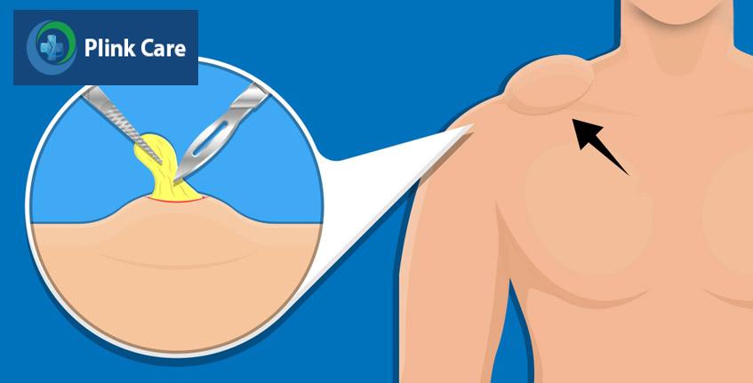 loại bỏ bằng phẫu thuật