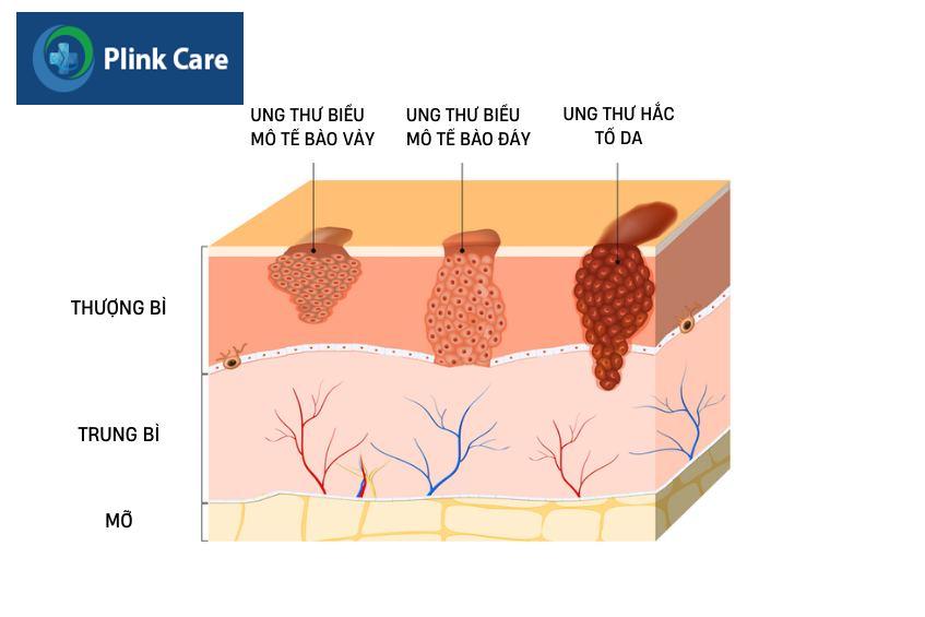 Các loại ung thư da phổ biến