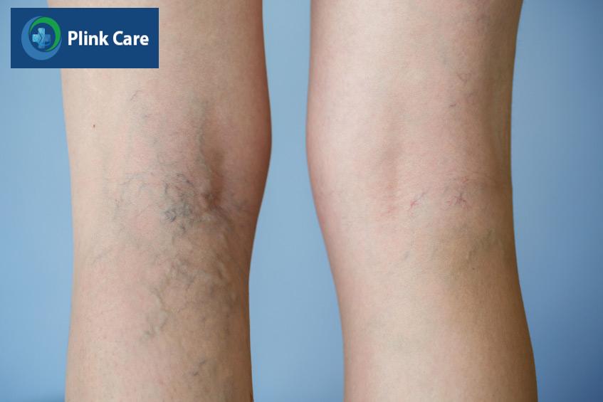 Những mạch máu bị tắc nghẽn khiến người bệnh đau nhức