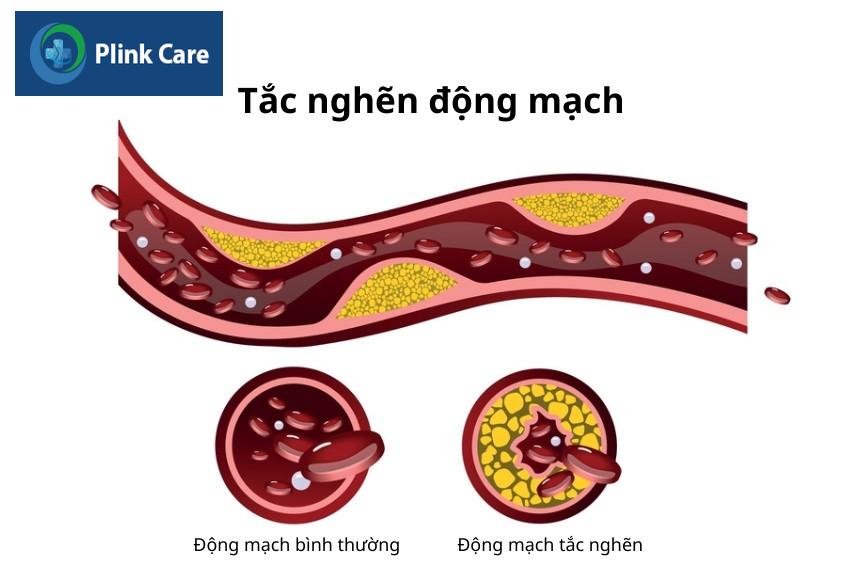 mỡ dưới da làm tắc nghẽn động mạch