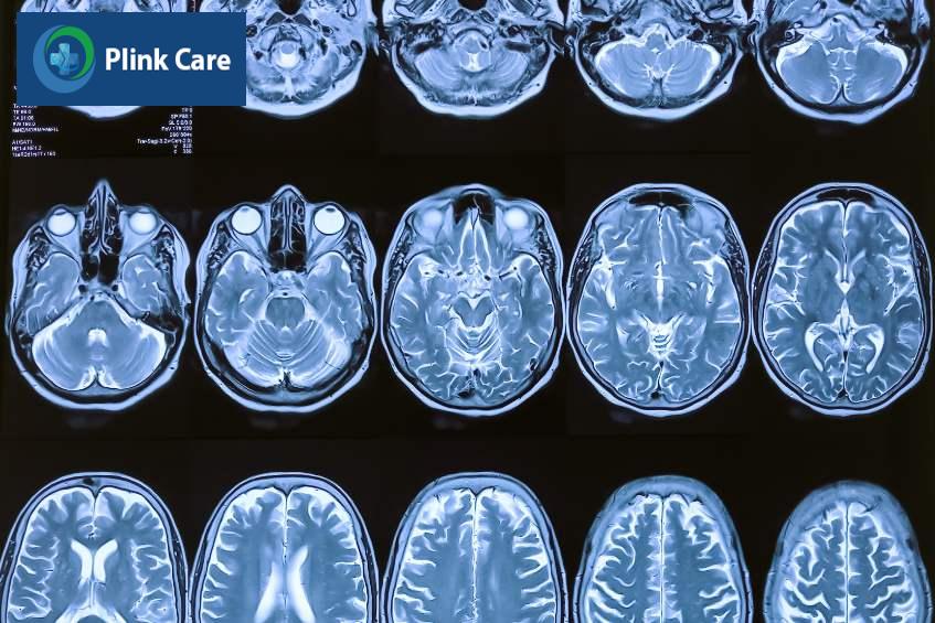 mri chẩn đoán bệnh teo não ở người trẻ tuổi