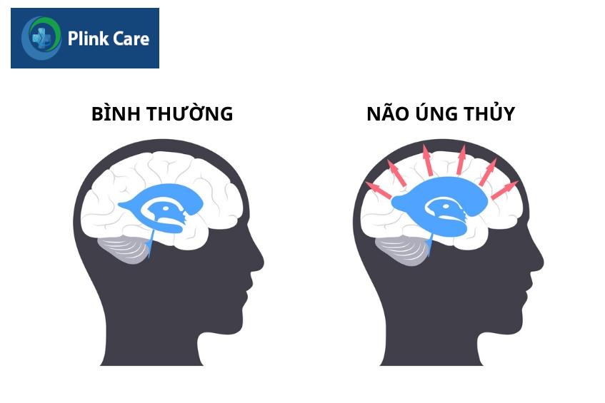 người bệnh xuất huyết dưới nhện có thể gặp biến chứng não úng thủy