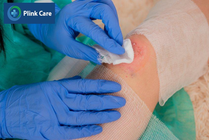 Nhẹ nhàng tháo lớp băng, gạc cũ ra khỏi vết bỏng