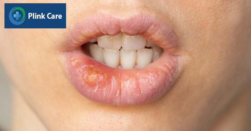 nhiễm trùng gây nhiệt miệng
