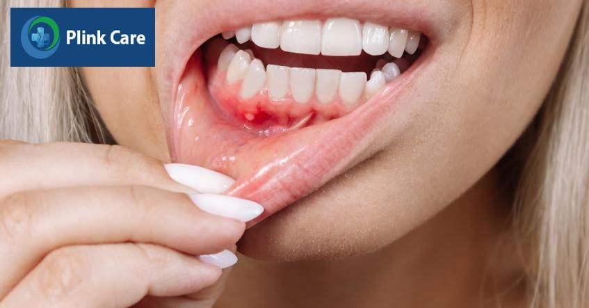 nhiệt miệng có nguy hiểm không