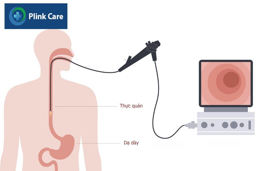 Nội soi giúp chẩn đoán trào ngược dạ dày gây ho ở trẻ em