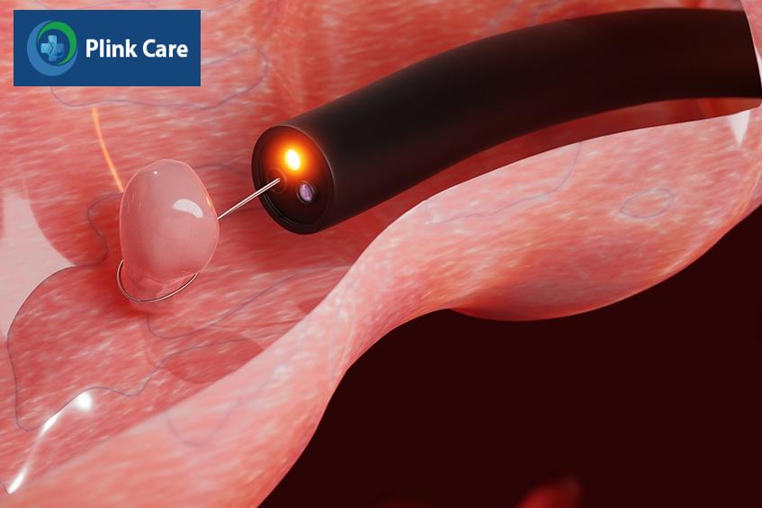 polyp đại tràng là một dạng tiền ung thư