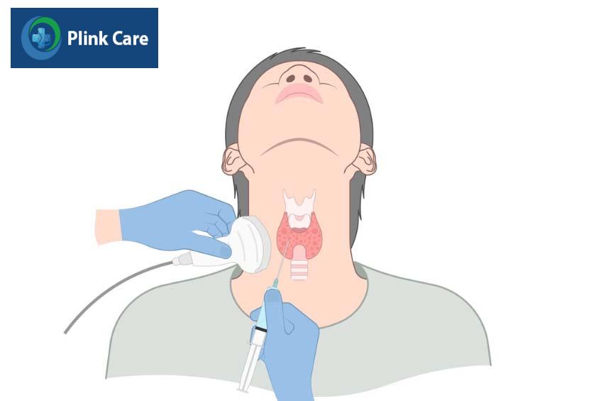 quy trình phẫu thuật u tuyến giáp