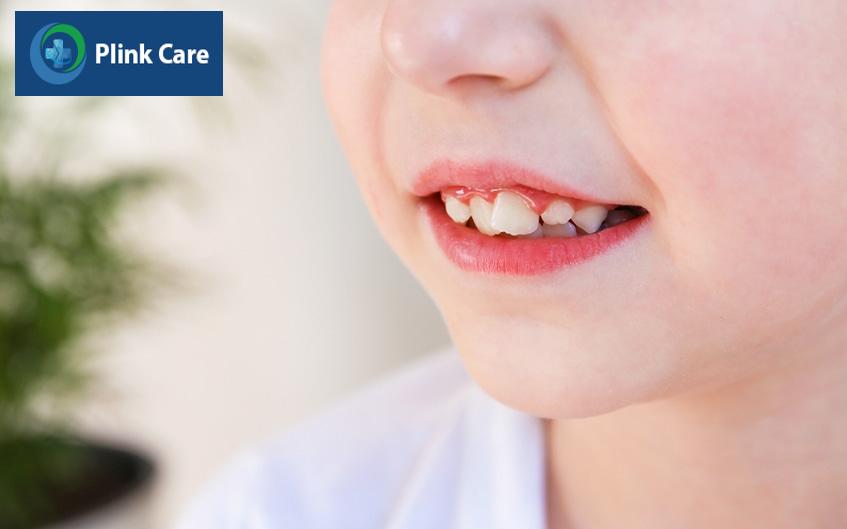 Dấu hiệu răng mọc lệch, răng lệch hàm