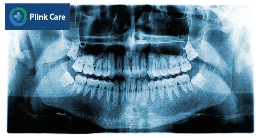 biến chứng của viêm lợi trùm răng khôn, ảnh hưởng đến các răng bên cạnh