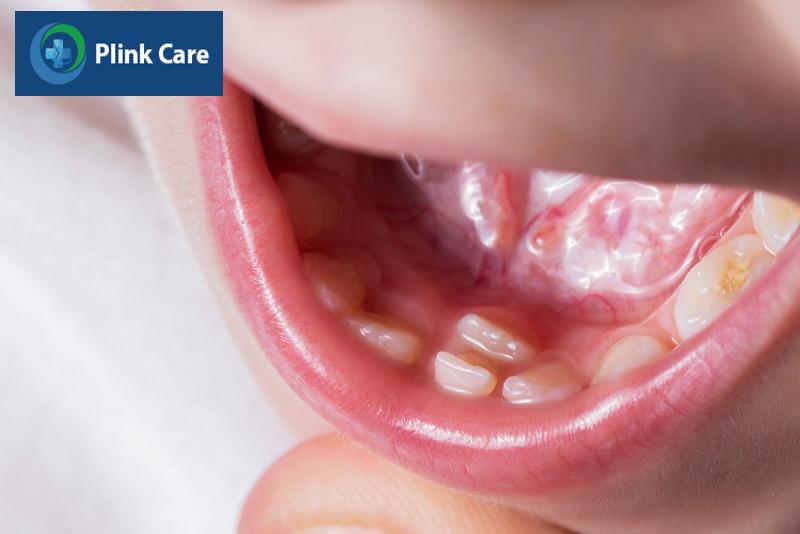 Răng mọc lẫy vào trong ở trẻ em