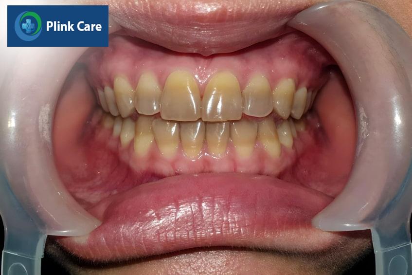 Răng nhiễm tetracycline là gì?