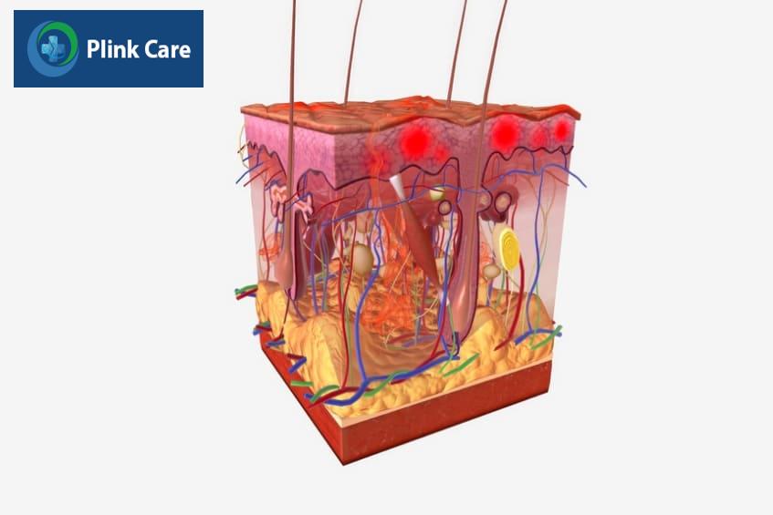 Sarcoma là khối u ác tính phát triển trong xương hoặc mô mềm