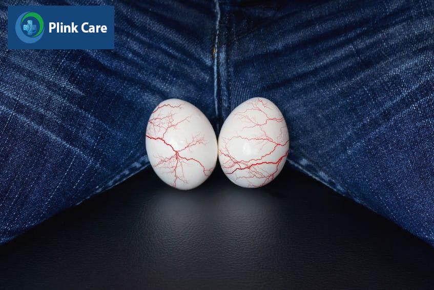 Sơ lược về bệnh giãn tĩnh mạch thừng tinh