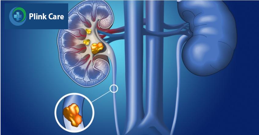 sỏi niệu quản 1 3 trên là gì