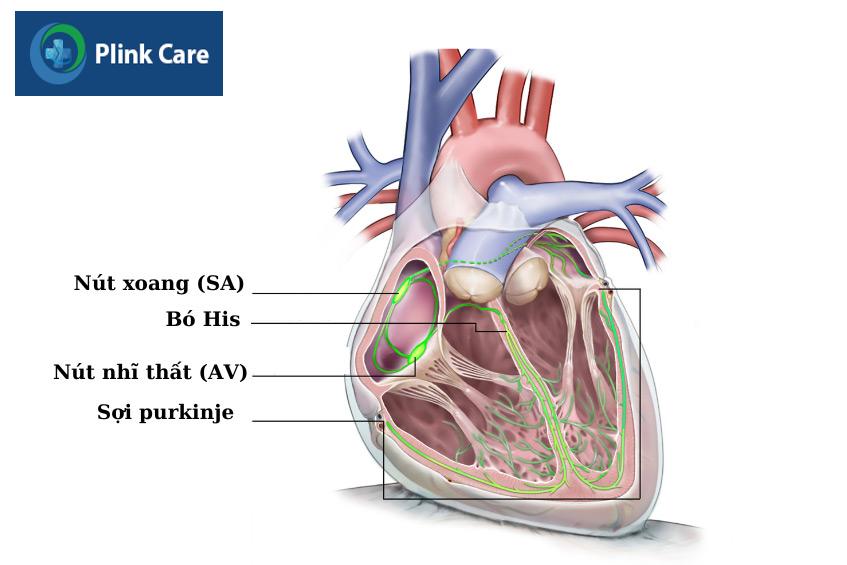 Suy nút xoang là loại rối loạn nhịp xuất phát từ nút xoang