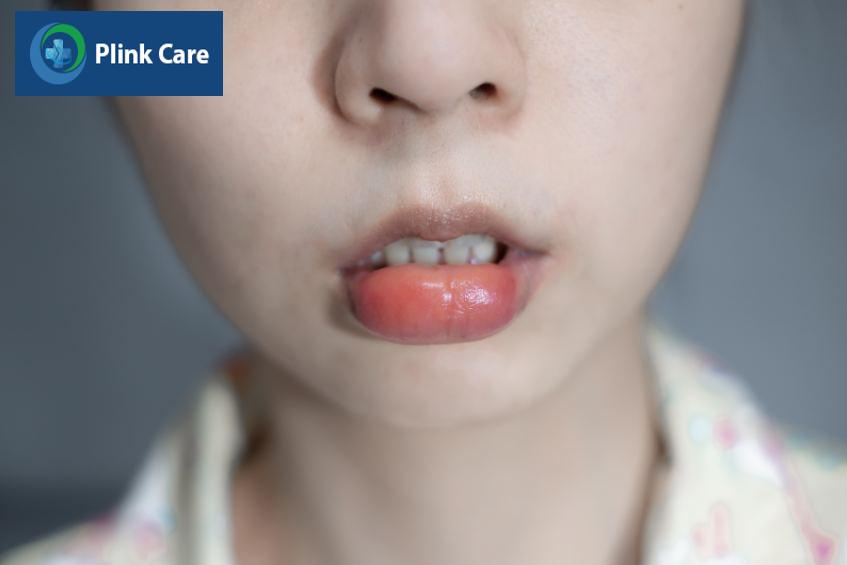 tác dụng phụ phù mạch ở miệng