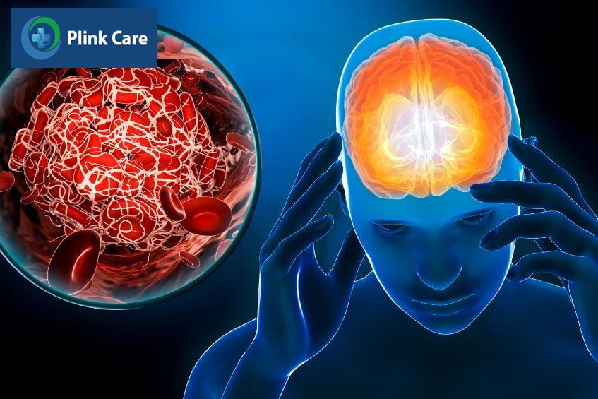 Thuốc kháng đông trong rung nhĩ nhằm giảm nguy cơ đột quỵ