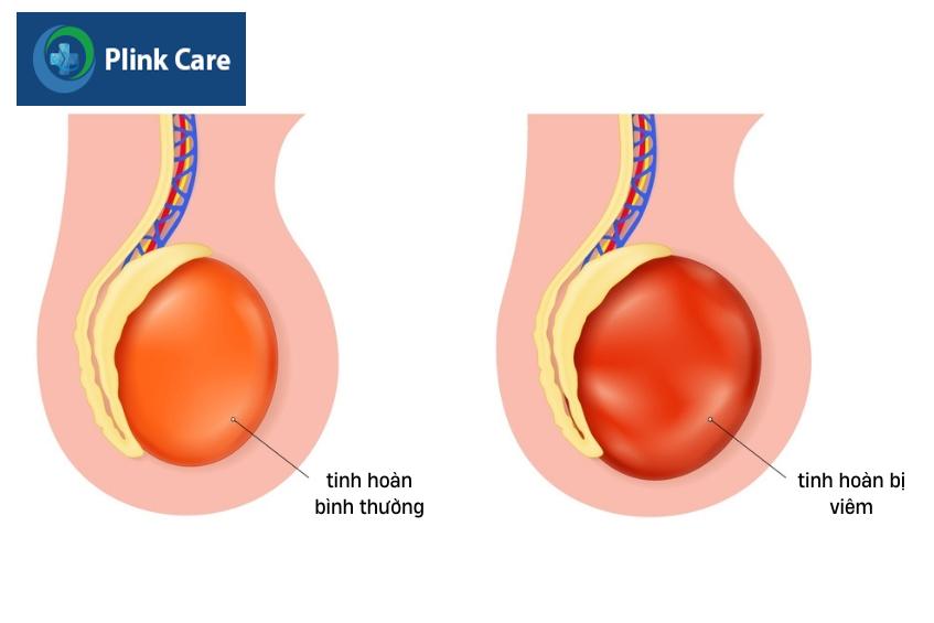 tinh hoàn bình thường và tinh hoàn bị viêm