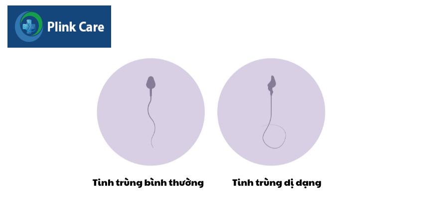 tinh trùng bình thường và tinh trùng dị dạng