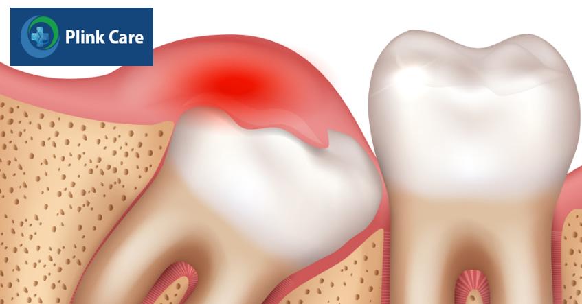 Triệu chứng viêm lợi trùm răng khôn