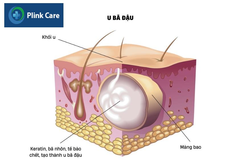 u bã đậu ở lưng là gì