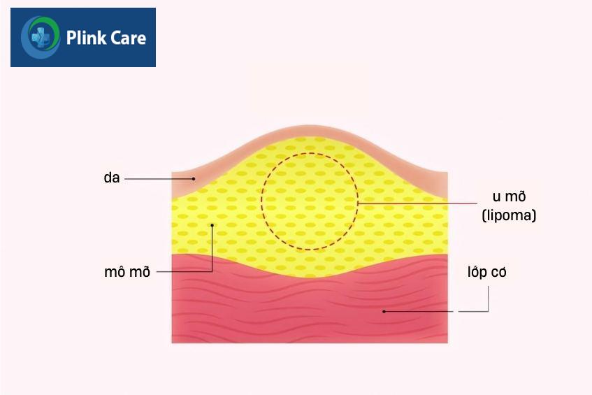 U mỡ (lipoma)