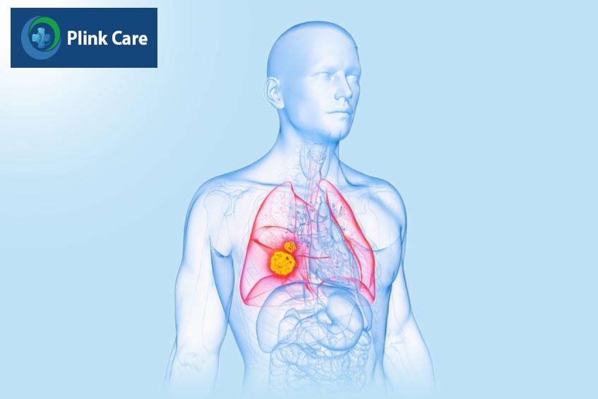 ung thư phổi có chữa khỏi được không