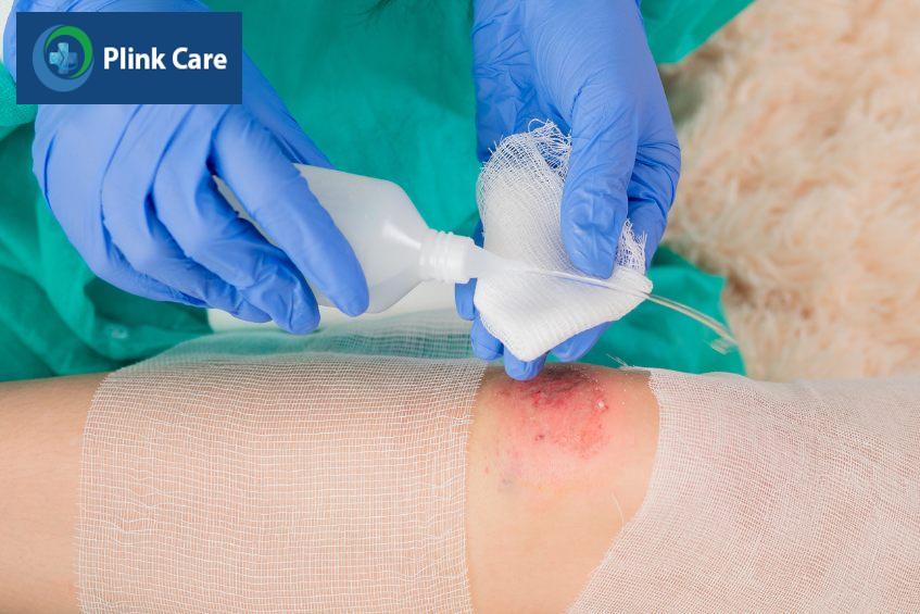 Vệ sinh vết bỏng đúng cách để loại bỏ dịch, mủ, tế bào chết