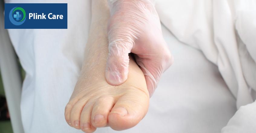 viêm cầu thận gây phù nề do giữ nước