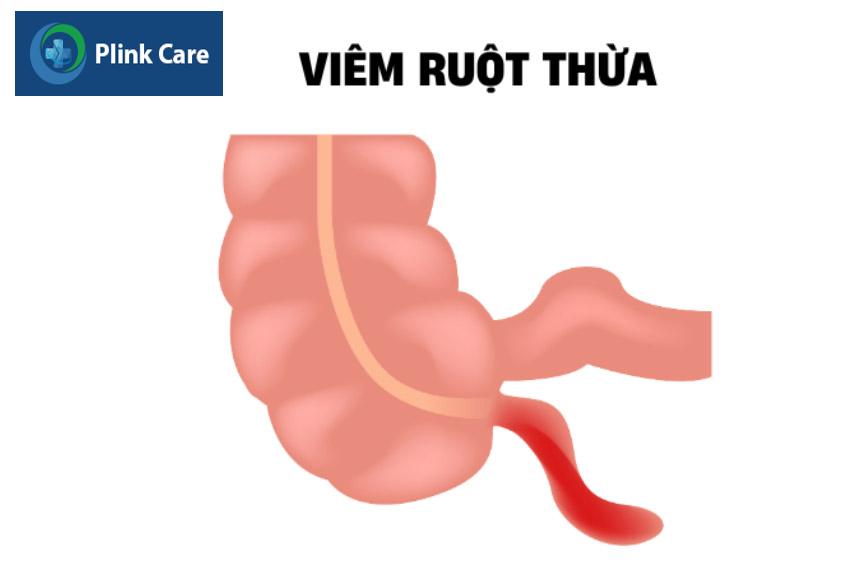 Viêm ruột thừa là viêm ở phần ruột nhỏ nối ruột già