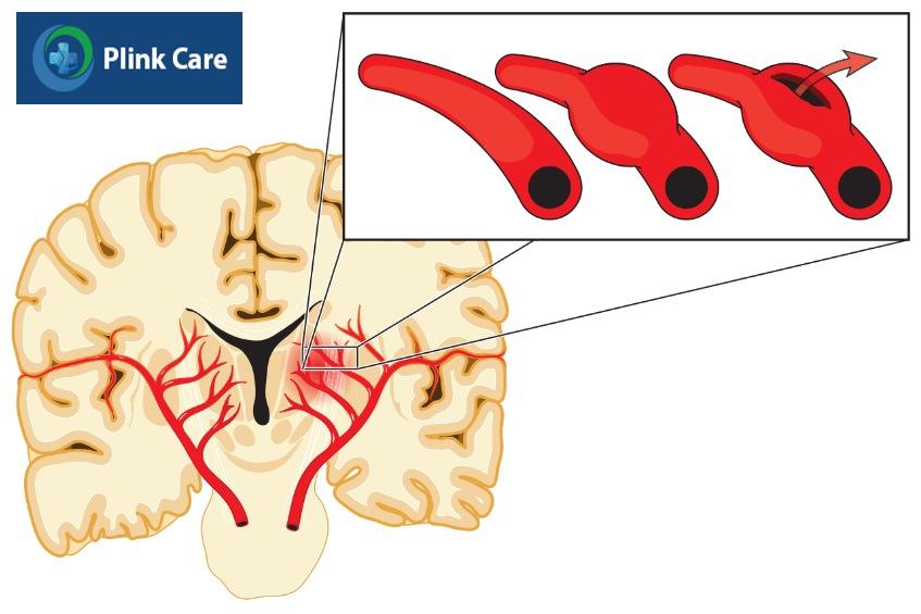 vỡ phình mạch gây xuất huyết dưới nhện