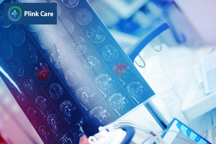 xuất huyết dưới nhện do phinh động mạch hoạc chấn thương