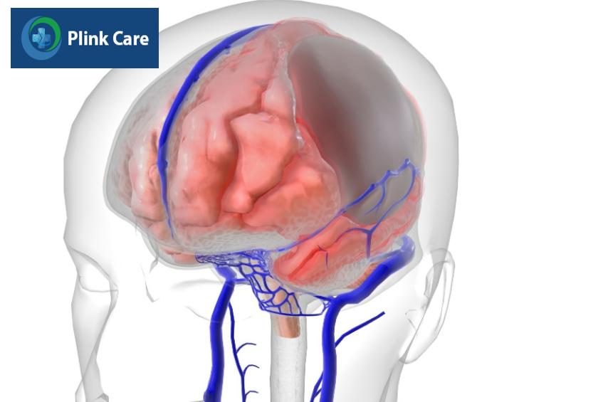 xuất huyết não có nhiều loại khác nhau