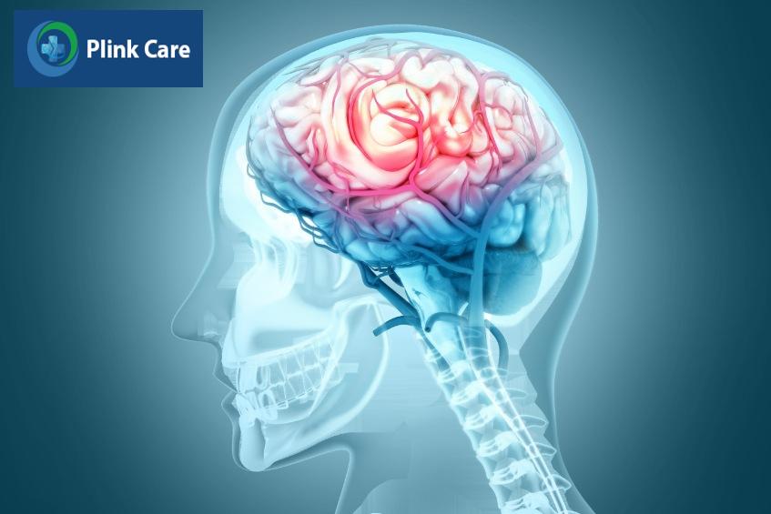 xuất huyết não xảy ra khi mạch máu não bị vỡ