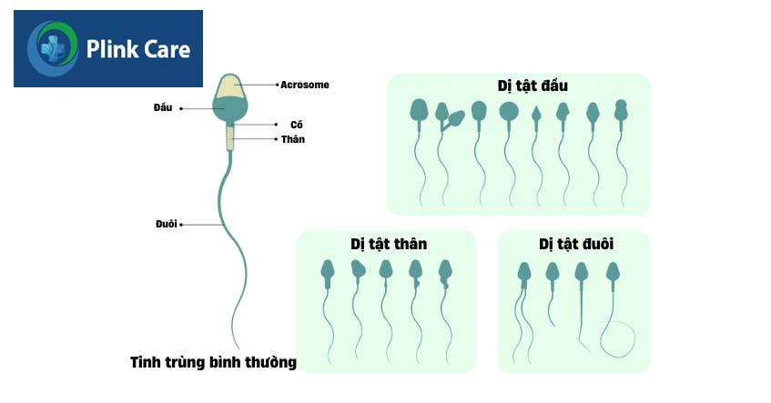 tinh trùng dị dạng có con được không