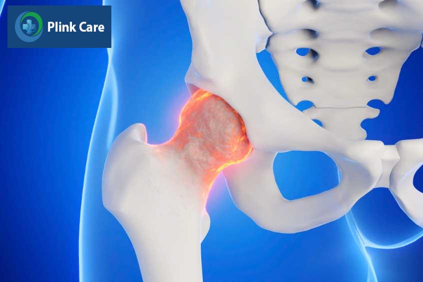 Bệnh loạn sạn khớp háng trẻ em