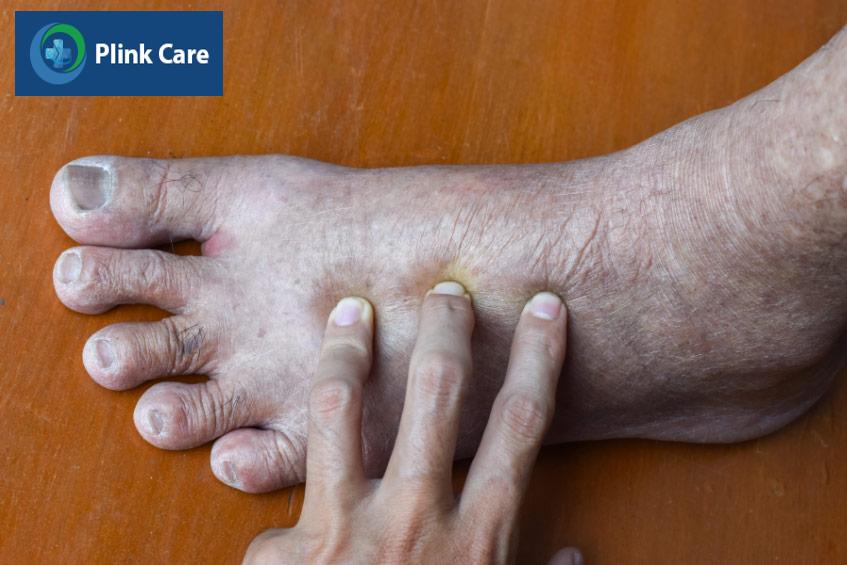 Bệnh nhân bị phù thũng ở chân