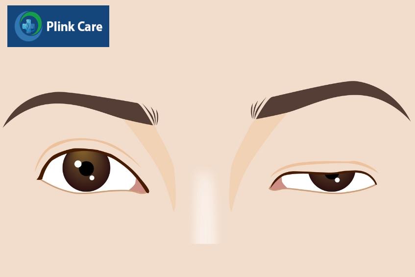 bệnh nhược cơ có thể tiến triển trong 1 đến 7 năm