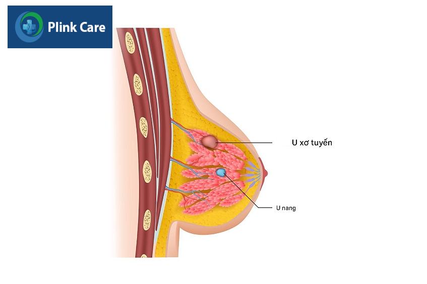 bệnh u xơ tuyến vú có nguy hiểm không