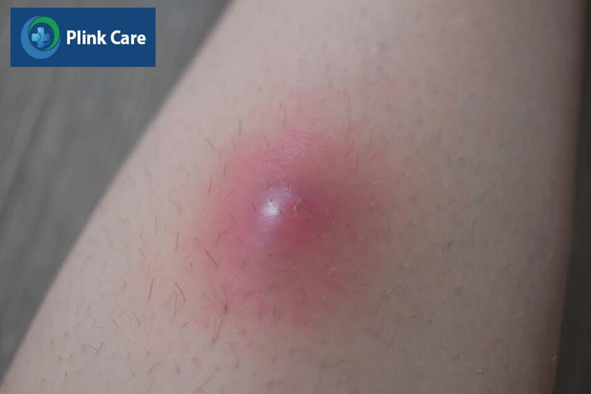 bị mụn nhọt khi nào nên gặp bác sĩ