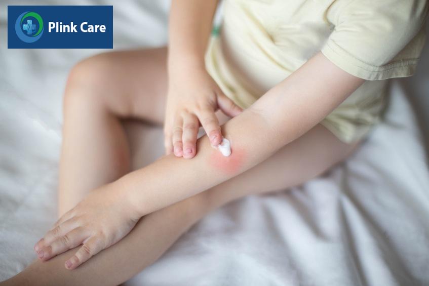 Bôi thuốc trị bỏng theo chỉ định của bác sĩ